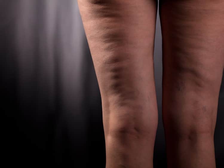 ¿Se puede eliminar la celulitis con dieta y ejercicio?