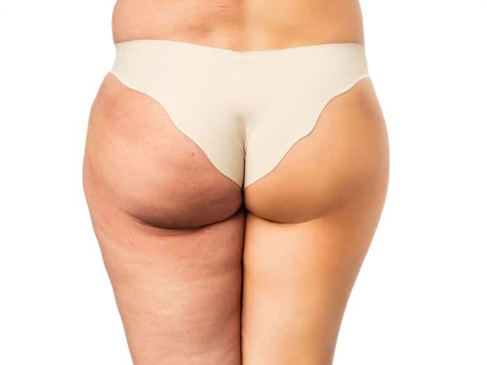 mejores-tratamientos-para-eliminar-celulitis