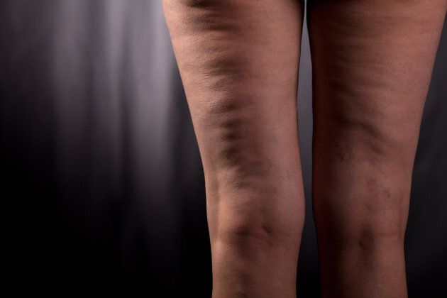 Claves para acabar con la celulitis: ¡Este verano luce cuerpazo!