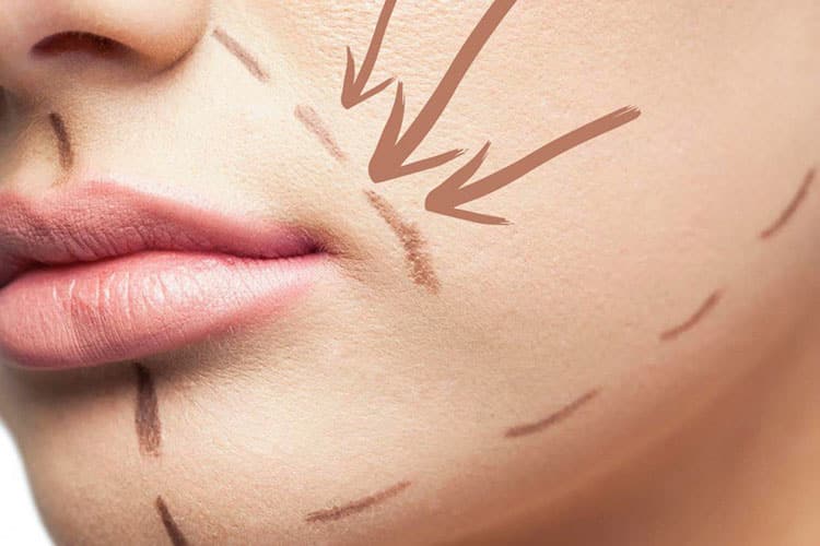 ¿Cómo tratar las arrugas de la risa?