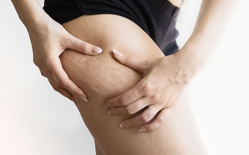Eliminar la celulitis de las piernas ya es posible con el Láser Lipolítico Adipolight