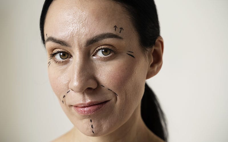 flacidez facial