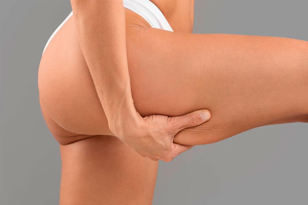 Tratamientos para la flacidez de piernas
